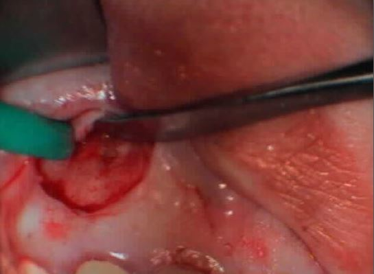 AKΡΟΡΡΙΖΕΚΤΟΜΗ ΣΤΗΝ ΑΝΩ ΓΝΑΘΟ 1