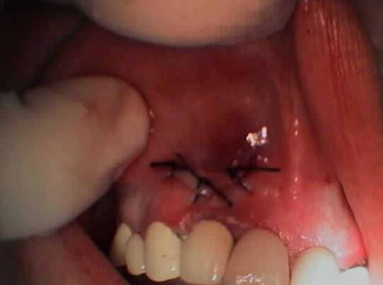 AKΡΟΡΡΙΖΕΚΤΟΜΗ ΣΤΗΝ ΑΝΩ ΓΝΑΘΟ 3