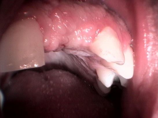 ΜΟΝΗΡΕΣ ΕΜΦΥΤΕΥΜΑ ΑΝΩ ΓΝΑΘΟΥ ΣΕ ΕΛΛΕΙΨΗ ΚΕΝΤΡΙΚΟΥ ΤΟΜΕΑ-ΚΟΛΛΗΤΗ ΕΡΓΑΣΙΑ 1