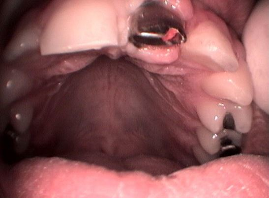 ΜΟΝΗΡΕΣ ΕΜΦΥΤΕΥΜΑ ΑΝΩ ΓΝΑΘΟΥ ΣΕ ΕΛΛΕΙΨΗ ΚΕΝΤΡΙΚΟΥ ΤΟΜΕΑ-ΚΟΛΛΗΤΗ ΕΡΓΑΣΙΑ 4