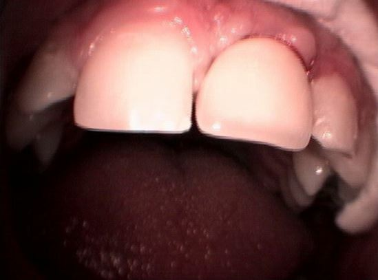 ΜΟΝΗΡΕΣ ΕΜΦΥΤΕΥΜΑ ΑΝΩ ΓΝΑΘΟΥ ΣΕ ΕΛΛΕΙΨΗ ΚΕΝΤΡΙΚΟΥ ΤΟΜΕΑ-ΚΟΛΛΗΤΗ ΕΡΓΑΣΙΑ 5