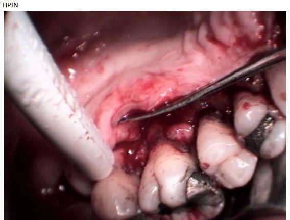 ΧΕΙΡΟΥΡΓΙΚΗ ΠΕΡΙΟΔΟΝΤΙΟΥ-ΘΕΡΑΠΕΙΑ ΠΕΡΙΟΔΟΝΤΙΤΙΔΑΣ 1