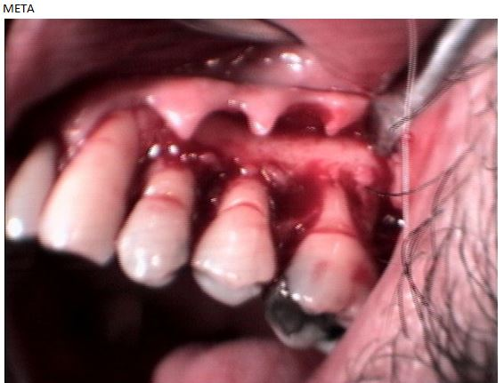 ΧΕΙΡΟΥΡΓΙΚΗ ΠΕΡΙΟΔΟΝΤΙΟΥ-ΘΕΡΑΠΕΙΑ ΠΕΡΙΟΔΟΝΤΙΤΙΔΑΣ 2