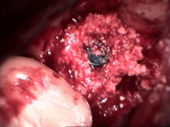 ΣΥΝΘΕΤΟ ΠΕΡΙΣΤΑΤΙΚΟ-ΤΡΙΑ ΕΜΦΥΤΕΥΜΑΤΑ ΣΤΗΝ ΚΑΤΩ ΓΝΑΘΟ KAI ENA ΕΜΦΥΤΕΥΜΑ ΣΤΗΝ ΑΝΩ ΓΝΑΘΟ 6