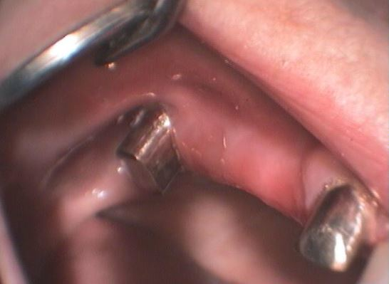 ΤΗΛΕΣΚΟΠΙΚΗ ΓΕΦΥΡΑ 2