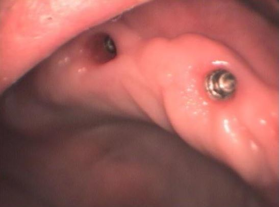 ΑΠΟΚΑΤΑΣΤΑΣΗ ΝΩΔΟΤΗΤΑΣ ΔΕΥΤΕΡΟΥ ΤΕΤΑΡΤΗΜΟΡΙΟΥ ΣΤΗΝ ΑΝΩ ΓΝΩΘΟ 2