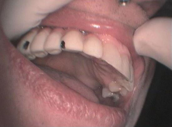 ΑΠΟΚΑΤΑΣΤΑΣΗ ΝΩΔΟΤΗΤΑΣ ΔΕΥΤΕΡΟΥ ΤΕΤΑΡΤΗΜΟΡΙΟΥ ΣΤΗΝ ΑΝΩ ΓΝΩΘΟ 4