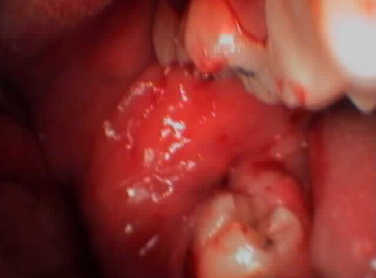 ΕΓΚΛΕΙΣΤΟΣ ΦΡΟΝΙΜΗΤΗΣ ΣΤΗΝ ΚΑΤΩ ΓΝΑΘΟ-ΧΕΙΡΟΥΡΓΙΚΗ ΕΞΑΓΩΓΗ 1