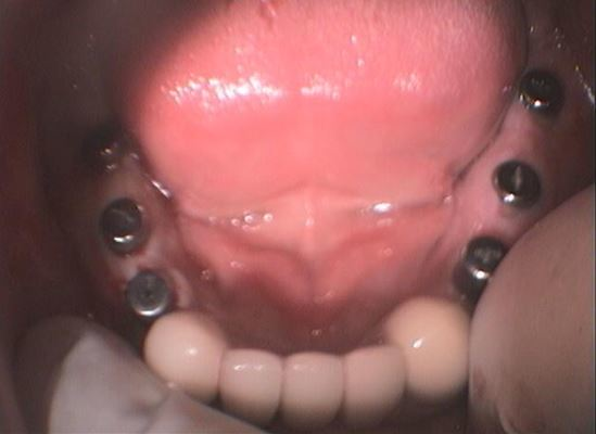 ΕΞΙ ΕΜΦΥΤΕΥΜΑΤΑ ΠΙΣΩ ΣΕ ΚΑΤΩ ΓΝΑΘΟ ΑΜΦΙΠΛΕΥΡΑ-ΚΟΧΛΙΩΤΗ ΕΡΓΑΣΙΑ 4