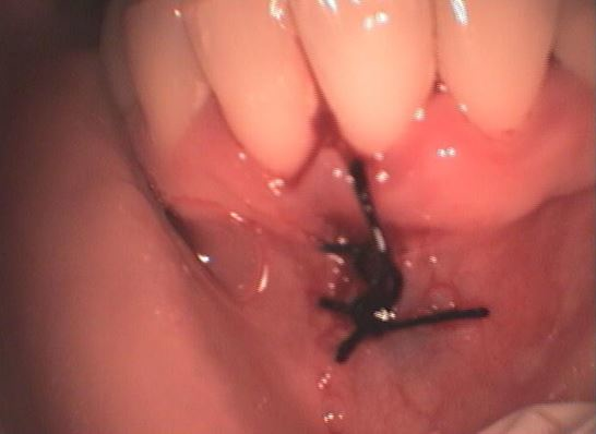 ΕΚΤΟΜΗ ΥΠΕΡΤΡΟΦΙΚΟΥ ΧΑΛΙΝΟΥ 3