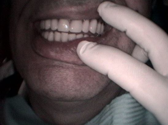 ΕΠΕΝΘΕΤΗ ΟΔΟΝΤΟΣΤΟΙΧΙΑ ΣΤΗΝ ΚΑΤΩ ΓΝΑΘΟ ΣΤΗΡΙΖΟΜΕΝΗ ΣΕ ΤΡΙΑ ΕΜΦΥΤΕΥΜΑΤΑ ΜΕ ΜΠΑΡΑ 5