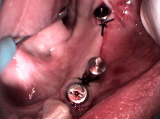 ΓΕΦΥΡΑ 5 ΤΕΜΑΧΙΩΝ ΜΕ ΕΜΦΥΤΕΥΜΑΤΑ ΣΕ ΣΥΝΔΥΑΣΜΟ ΜΕ BIO OSS 2