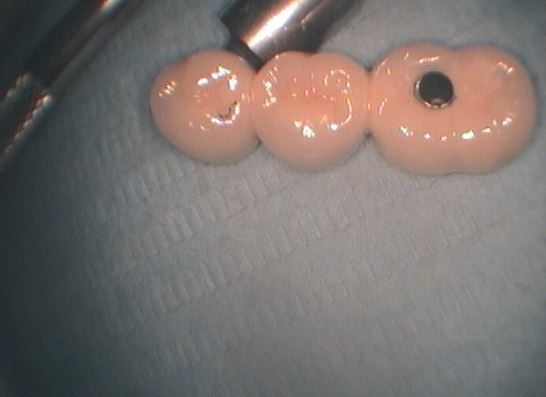 ΓΕΦΥΡΑ ΣΤΗΝ ΚΑΤΩ ΓΝΑΘΟ-ΦΥΣΙΚΟ ΔΟΝΤΙ ΜΕ ΕΜΦΥΤΕΥΜΑ 2