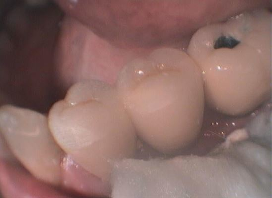 ΓΕΦΥΡΑ ΣΤΗΝ ΚΑΤΩ ΓΝΑΘΟ-ΦΥΣΙΚΟ ΔΟΝΤΙ ΜΕ ΕΜΦΥΤΕΥΜΑ 3