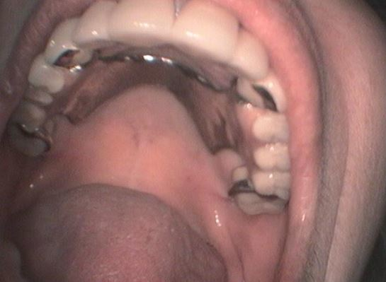 ΜΕΡΙΚΗ ΟΔΟΝΤΟΣΤΟΙΧΙΑ ΜΕ ΣΥΝΔΕΣΜΟΥΣ ATTACHMENT ΣΕ ΠΕΡΙΠΤΩΣΗ ΑΝΟΔΟΝΤΙΑΣ ΣΤΟ ΠΙΣΩ ΜΕΡΟΣ ΤΗΣ ΑΝΩ ΓΝΑΘΟΥ 5